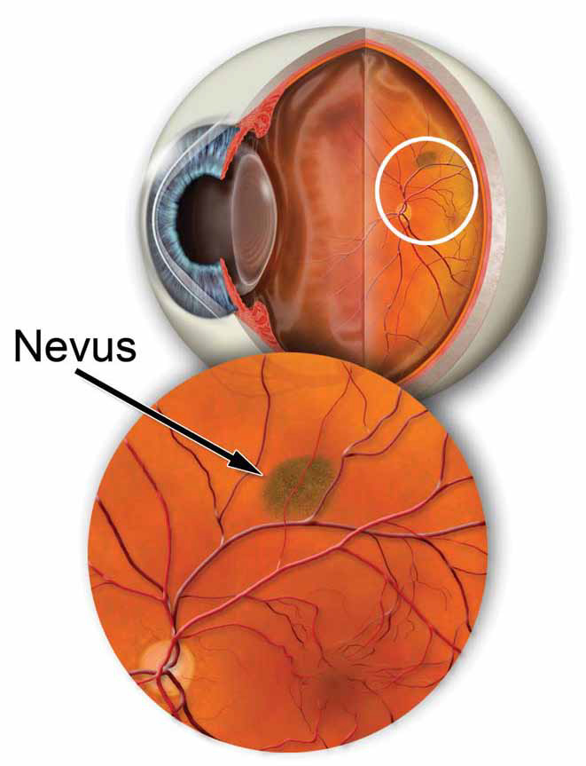 Pigmented Retinal Lesions & Choroidal Nevus