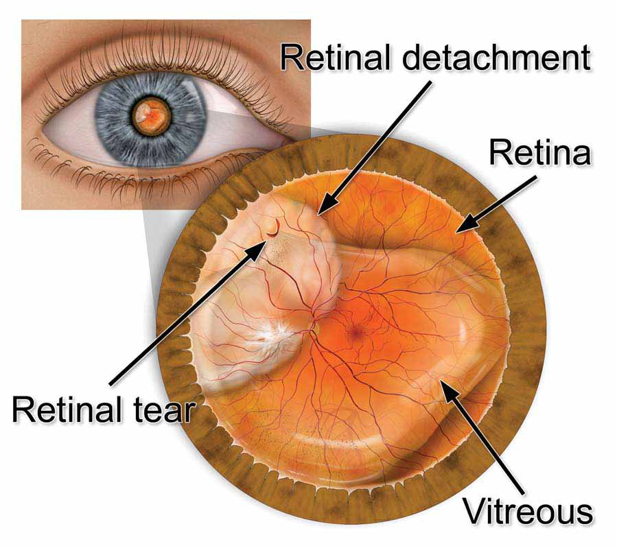 Retinal Tears & Retinal Detachment