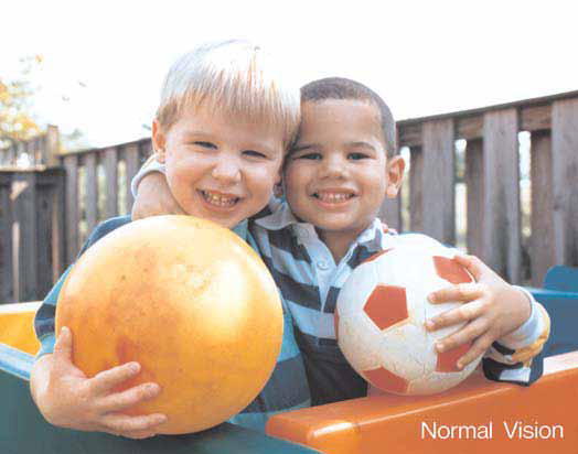 Macular Degeneration Normal Vision
