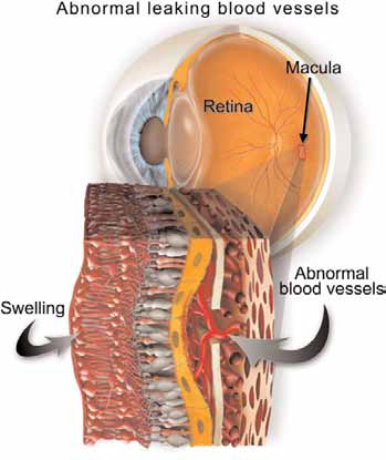 Wet Macular Degeneration