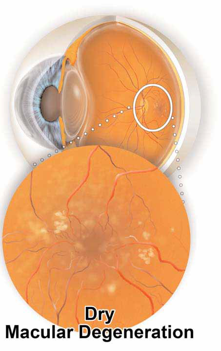 Dry macular Degeneration