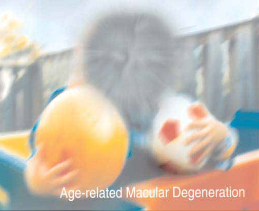 Macular Degeneration Age Related